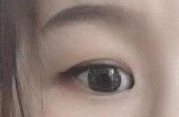 開內(nèi)眼角的手術(shù)費(fèi)用多少？術(shù)后禁忌癥有哪些？