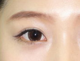 開內(nèi)眼角安全嗎？