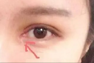 開眼角割雙眼皮拆線嗎？術(shù)后拆線疼嗎？