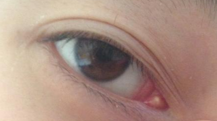 開眼角多久能恢復(fù)？