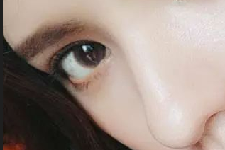 開(kāi)眼角有害嗎？開(kāi)眼角有疤痕嗎？