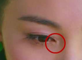 開眼角要增生多久？