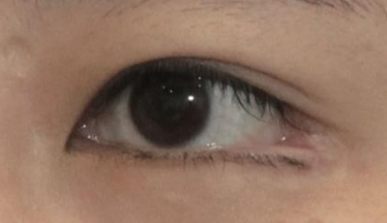 開眼角是永久的嗎？開眼角用什么防止增生？