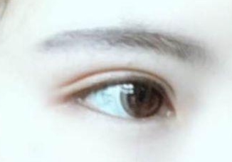 開(kāi)眼角有沒(méi)有副作用？