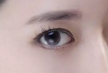 開眼角術(shù)后會不會反彈？