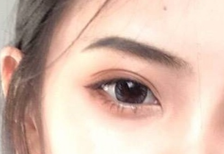 開(kāi)眼角手術(shù)怎么樣？