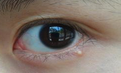 開外眼角手術(shù)會有后遺癥嗎？