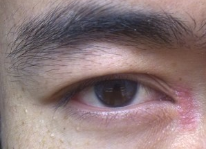 開(kāi)眼角術(shù)后如何快速消腫？