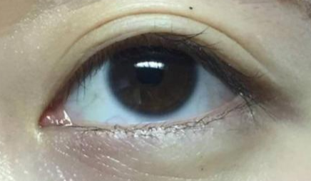 開眼角手術(shù)多長時間恢復？