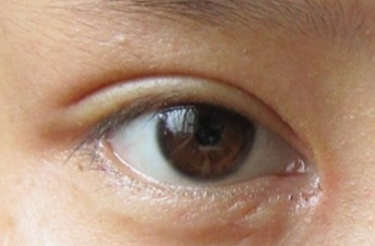 開眼角手術(shù)會不會留疤？開眼角手術(shù)后應(yīng)該注意什么？