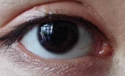 做開眼角疼不疼？做開眼角要多少錢？