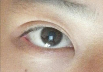 開(kāi)眼角手術(shù)后會(huì)影響視力嗎？開(kāi)眼角手術(shù)費(fèi)用貴嗎？