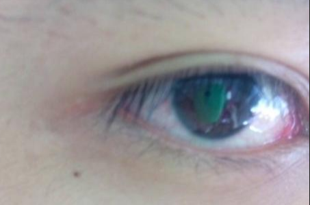 開眼角手術(shù)完全恢復(fù)需要多長時間？術(shù)后如何避免留疤？