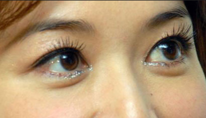 開眼角手術的優(yōu)點有哪些？