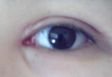 做一次開眼角多少錢？