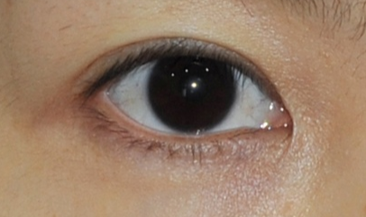 做完開眼角怎樣護(hù)理？