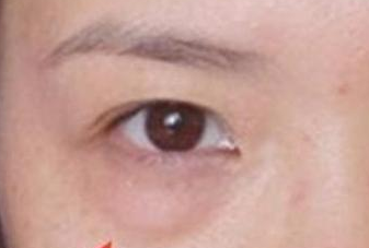 光纖溶脂去眼袋手術(shù)有哪些優(yōu)勢(shì)？