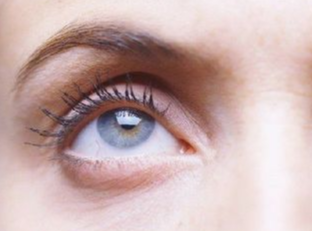 埋線祛眼袋什么時(shí)候做好？