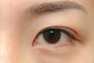 光纖溶脂祛眼袋有效果嗎？光纖溶脂祛眼袋好不好？