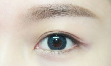 開眼角需要注意的事項(xiàng)有哪些？