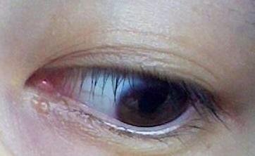 不開刀去眼袋多少錢？