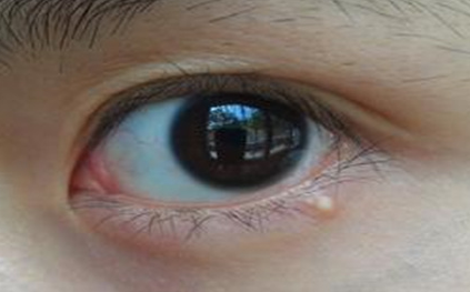 不開刀去眼袋安全嗎？不開刀去眼袋多少錢？