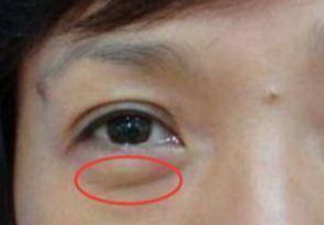 埋線去眼袋能維持多久？