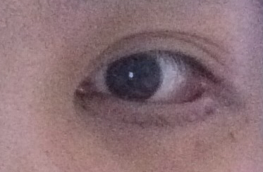 埋線去眼袋有效嗎？