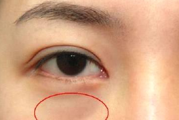 光纖溶脂祛眼袋需要多少錢？光纖溶脂怎么樣呢？