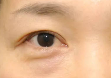 什么是埋線去眼袋？埋線去眼袋能維持多久？