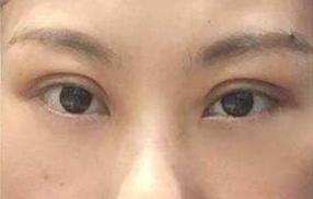 激光去眼袋能維持多長時間？祛眼袋的手術(shù)效果好嗎？