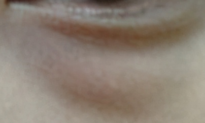 激光去眼袋和內(nèi)切哪個好？