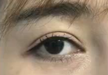 激光祛眼袋痛不痛？激光祛眼袋手術怎么樣？