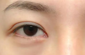 激光去眼袋多久做一次？激光去除眼袋后遺癥有哪些？