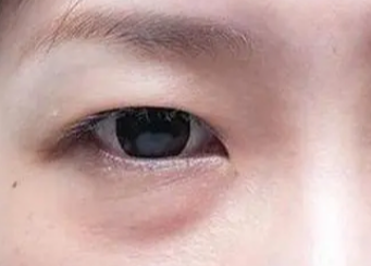 激光祛眼袋有用嗎？