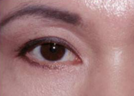 激光可以去眼袋嗎？祛除眼袋是用激光好還是手術(shù)好？