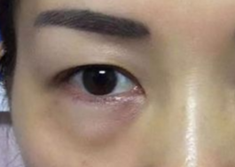 激光可以祛眼袋嗎？激光祛眼袋有哪些副作用？