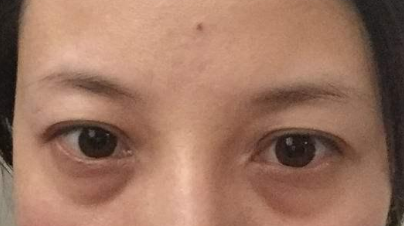 激光祛除眼袋有效嗎？激光祛眼袋有什么利弊？