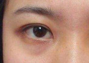 去眼袋是激光好還是內(nèi)切好？激光祛眼袋是什么原理？