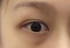 激光祛眼袋要多少錢？