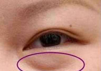 激光祛眼袋有什么好處？