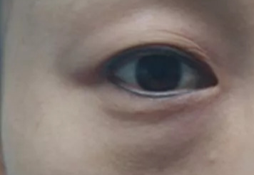 激光去眼袋可以管多久？