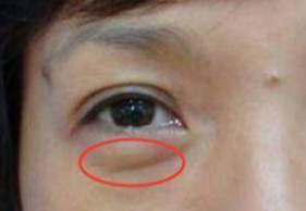 激光去眼袋可以管多久？激光祛眼袋多久可以恢復(fù)？