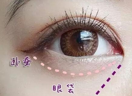 激光消除眼袋怎么樣？激光溶脂去眼袋多少錢？