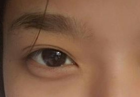 激光去眼袋后需多久能恢復(fù)？激光去眼袋快速有效嗎？