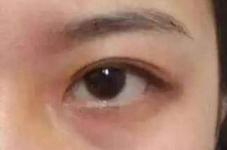 激光祛眼袋效果真的好嗎？