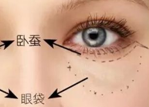 激光去眼袋多久才能恢復(fù)？激光去眼袋有什么副作用嗎？