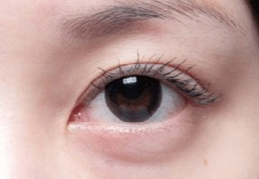 激光去眼袋會不會很疼？