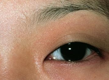 激光祛眼袋可靠嗎？