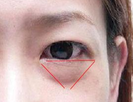 激光除眼袋效果如何？激光去眼袋要注意什么？